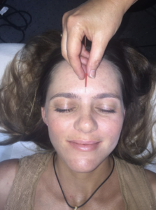 A young women getting an acupuncture treatment on her face.